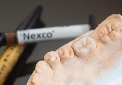 Inlays vs Onlays: What’s the Difference?